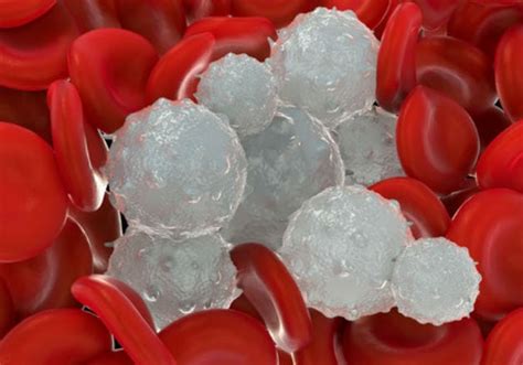 Taux élevés De Globules Blancs Leucocytes Dans Le Sang Les Causes