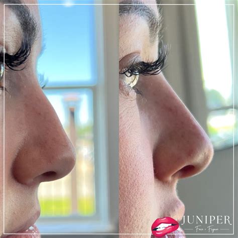 Non Surgical Nose Job 5 Juniper Face Figure