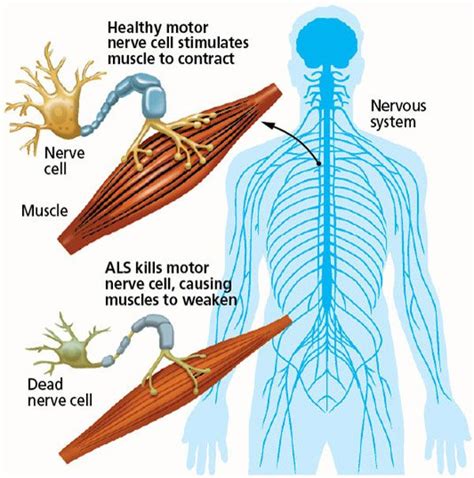 Graphic What Is Als Amyotrophic Lateral Sclerosis