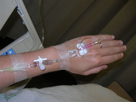 Intravenous Therapy Wikidoc