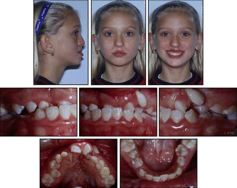 Ideal Treatment Protocol For Cleft Lip And Palate Patient From Mixed To