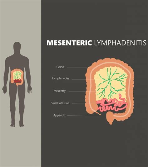 Mesenteric Lymphadenitis In Children Symptoms And Treatment
