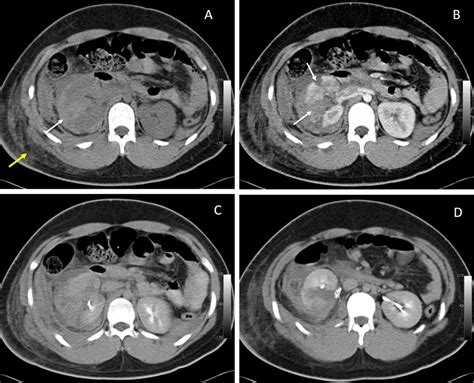 Infected Perinephric Hematoma Radiology Cases