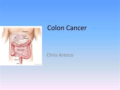 Ppt Colon Cancer Powerpoint Presentation Free Download Id2360697