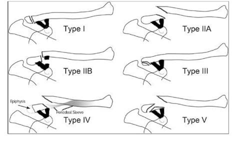Figure 1 From Current Concepts In The Management Of Clavicle Fractures