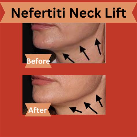 What Is A Nefertiti Neck Lift — Dr Heather Friedman Nd Lac