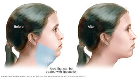 Chin Liposuction