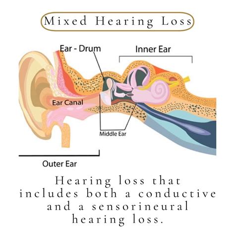 4 Different Types Of Hearing Loss — Physicians Hearing Solutions