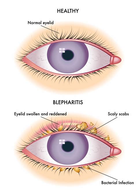 Seborrheic Dermatitis Eyelids Causes Javsystema