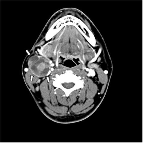 Extrathyroid Carcinoma Showing Thymus Like Differentiation Castle A