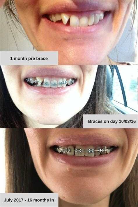 Pin On Adult Braces Before After Cosmetic Dentistry