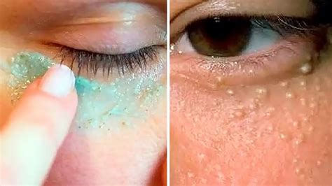 How To Get Rid Of Milia At Home Safe Easy And Scar Free