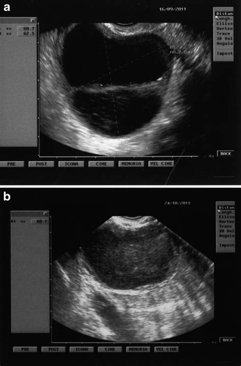 A Cystic Corpus Luteum With Reticular Appearance In A Previously Normal Download Scientific