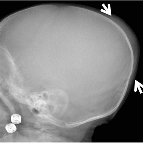 Skull X Ray Of Case 2 Shows Soft Tissue Swelling In Parieto Occipital
