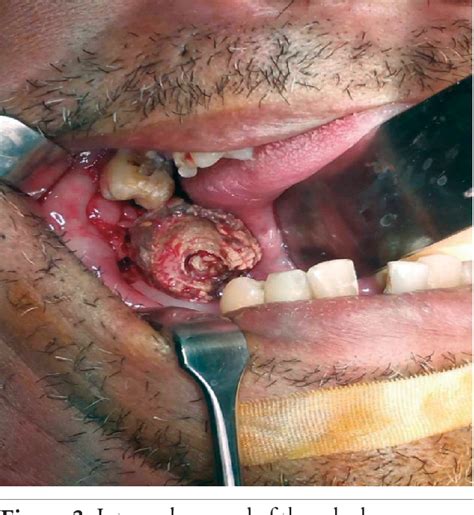 Pdf Giant Submandibular Calculus Eroding Oral Cavity Mucosa Hot Sex