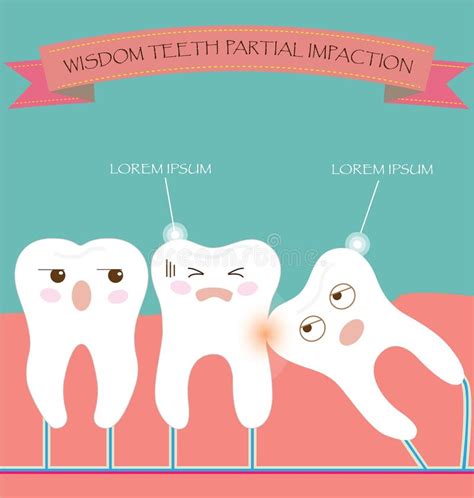 Wisdom Teeth Partial Eruption Impaction Stock Vector Illustration Of
