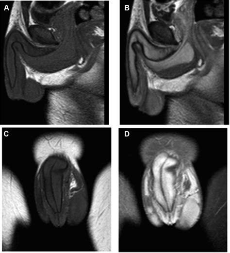 Patient Magnetic Resonance Imaging Mri Of The Penis After Download Scientific Diagram