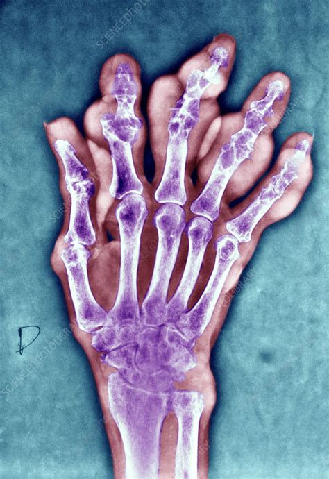 X Ray Of Arthritic Hand Stock Image C0044496 Science Photo Library