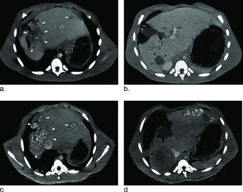 Contrast Enhanced Computed Tomography Ct Transverse Scan Of The Liver