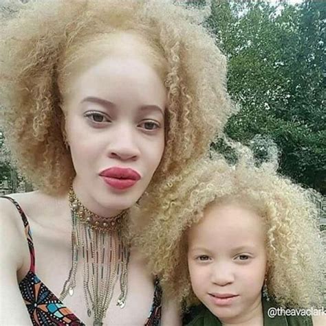 10 Stunning Photos Of Black Albinos From The Inmyskiniwin Campaign