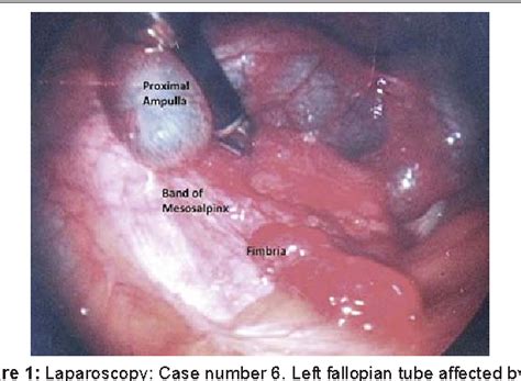Figure 1 From Congenital Ampullary Atresia Of The Fallopian Tube And
