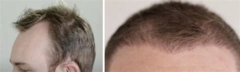 Hair Transplant After 4 Months Photos Results Side Effects