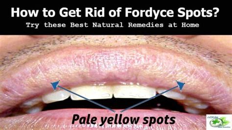 How To Get Rid Of Fordyce Spots On Lips 6 Best Remedies