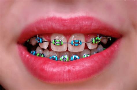 Braces Colors Choosing The Perfect Shade For Your Smile The Teeth