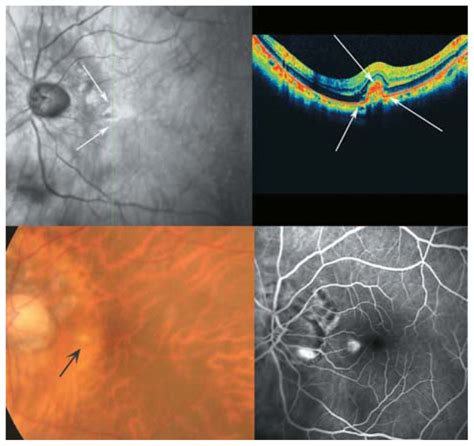 Another Example Of Choroidal Neovascularization In The Extrafoveal Area