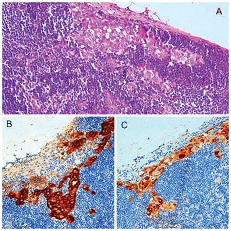 Prognostic Implications Of Node Metastatic Features In Oscc A