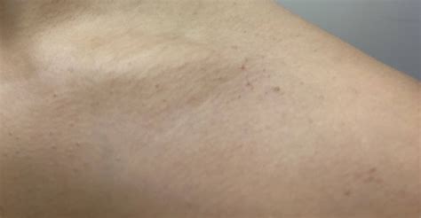 Skin Concern Weird Bumps On Collar Bone Shoulder Skincareaddiction