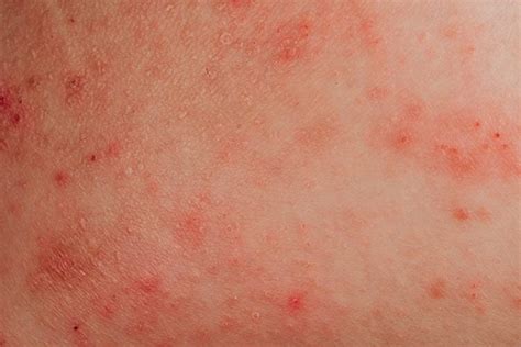 Eczema Triggers 15 Causes You Might Be Ignoring The Healthy