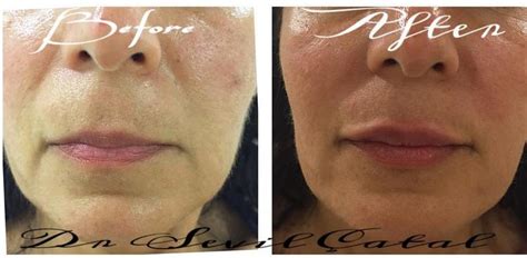 Botox To Treat Marionette Lines Before And After 1 Facial