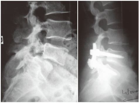 A 36 Year Old Man Presented With L5 S1 Isthmic Spondylolisthesis He