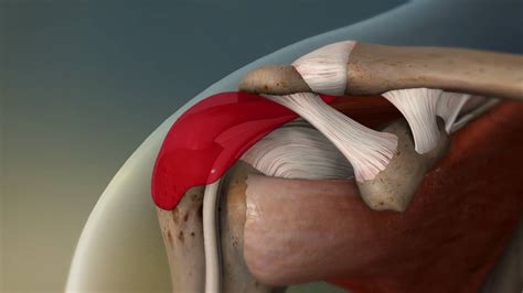 Bursite No Ombro Subacromial Bursitis Shoulder Impingement Bursitis