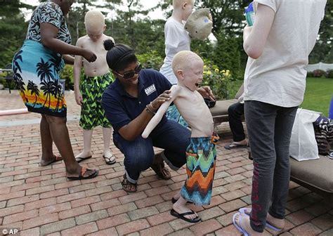 Dismembered African Albino Children Given Prosthetic Limbs In Us