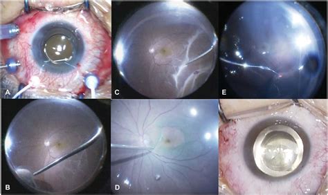 Typical Intraoperative Photographs Of The 27 G Vitrectomy System A