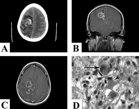 A Presenting Ct Scan Without Contrast Demonstrating A Right