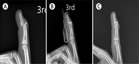 Union Of Mallet Fracture A The Pre Operative Radiograph Showed Mallet