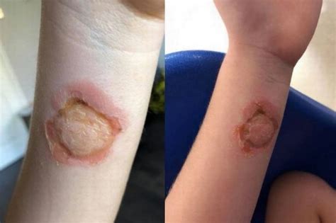 Seven Year Old Girl Hospitalised After Spider Bite Eats Away Childs