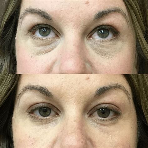 Tear Trough Fillers Before And Afters Oklahoma City Okc H Md