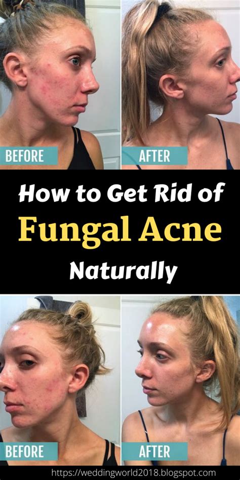 How To Get Rid Of Fungal Acne Naturally Wedding And Women Life