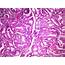 Adenocarcinoma Acinar Type Mucinous  Yale Rosen Flickr
