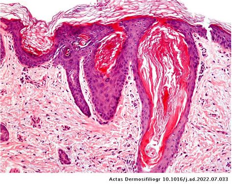 Linear Hyperkeratotic Papules In A Full Term Newborn Actas Dermo