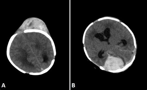 A Subgaleal Hematoma With A Dimension At The Left Frontoparietal