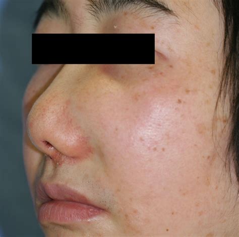 Appearance Of The Swelling In The Left Nasal Wing At The Initial