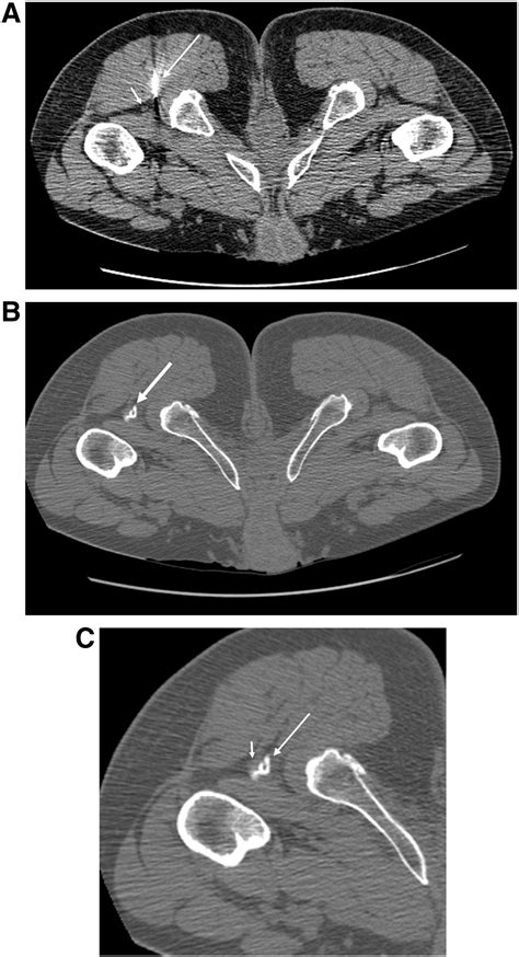 Clunealgia Ct Guided Therapeutic Posterior Femoral Cutaneous Nerve