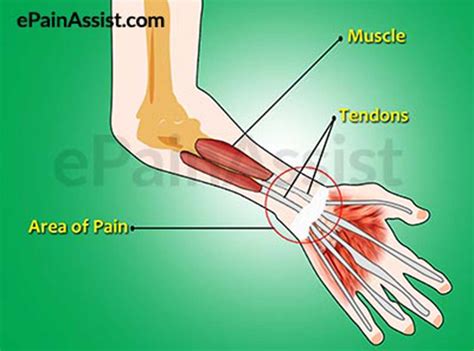 Wrist Tendon Pain