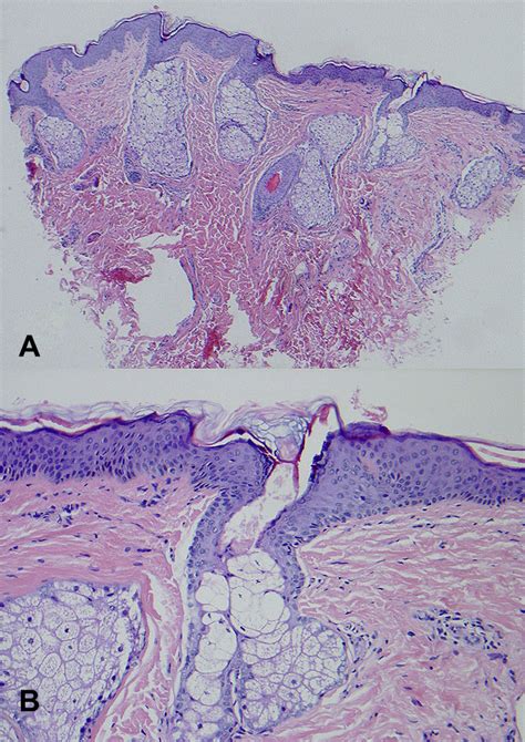 Disseminated Eruption Of Ectopic Sebaceous Glands Following Stevens