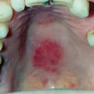 The Concomitant Lesion Of Mrg Which Is Called Kissing Lesion